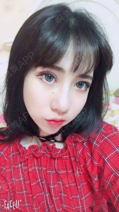 眼综合术后24天_开眼角术后24天_眼部术后24天_高冷戏精就是我啦分享