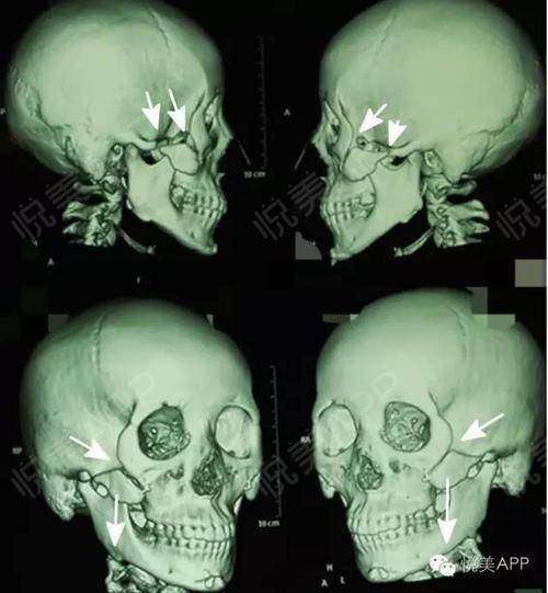 苹果肌和颧骨都分不清楚还想去做小脸术省省吧你