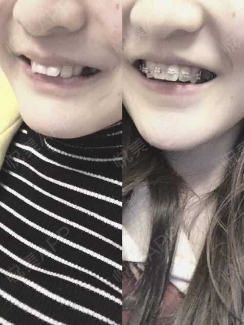 我和牙套在一起的半个月里,我感受到了牙套真正的魅力所在,刚开始两三