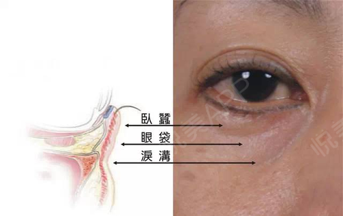 泪痕沟是如何形成的?