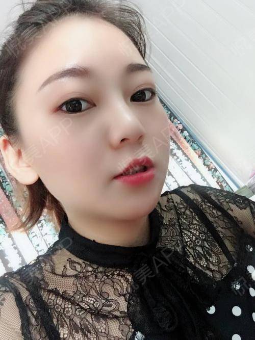 半永久纹眉术后111天_半永久化妆术后111天_皮肤美容术后111天_hot