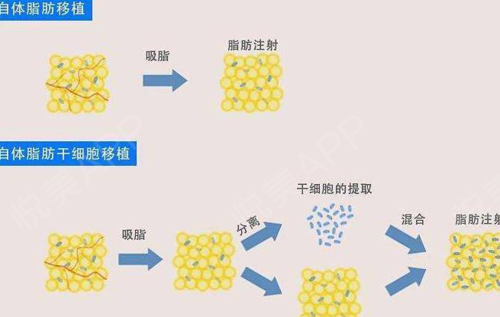 自体脂肪填充后十天图,毁容了有前后对比照片,出现了面部凹陷,僵硬