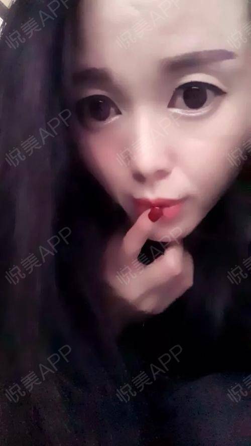 小阴唇整形术后28天_女性私密术后28天_私密整形术