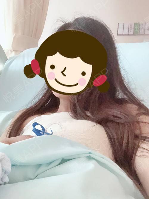 乳晕缩小术后1天_乳房下垂矫正术后1天_乳头缩小术后1天_胸型美化术后