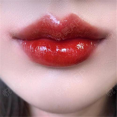 为了让自己的唇部更加的性感和漂亮,很多女性选择唇部整形,但是效果却