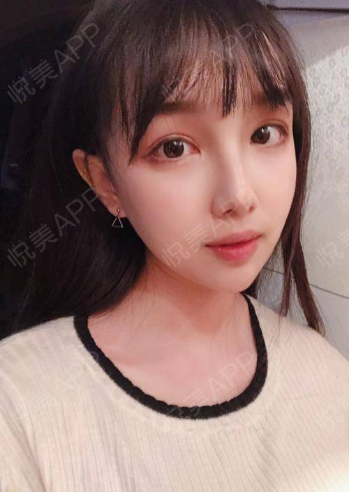 颧骨颧弓整形术术后30天_颧骨颧弓整形术后30天_面部轮廓术后30天