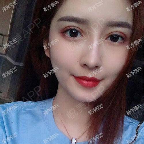 天_开眼角术后334天_双眼皮术后334天_眼部术后334天_猫大财分享图片2