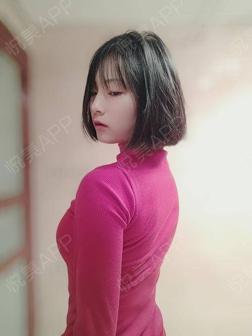 复合隆胸术后232天_自体脂肪面部填充术后232天_乳房下垂矫正术后232