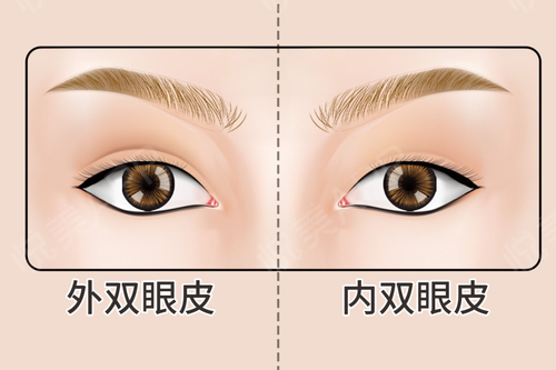 内双想要双眼皮，提眉和双眼皮手术哪个好？